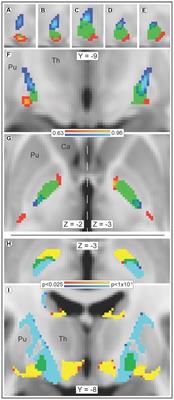 In humans, striato-pallido-thalamic projections are largely segregated by their origin in either the striosome-like or matrix-like compartments